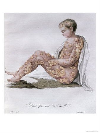 Ringworm, from a Book by Baron Jean Louis Alibert 1838