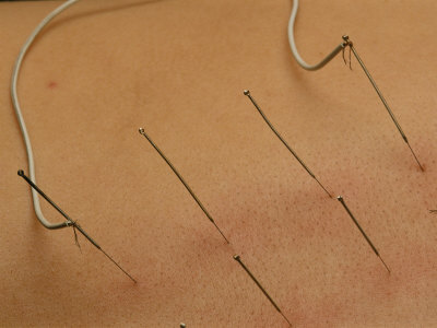 Close View of Accupuncture Needles Treating a Stomach Ailment