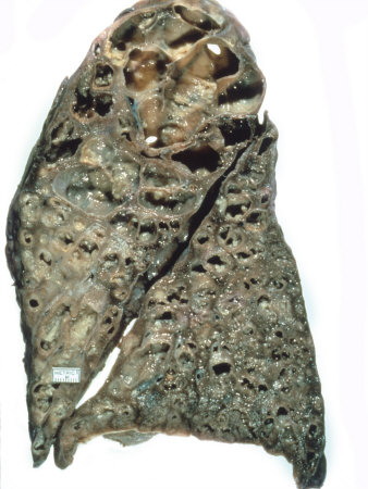 Lung with Cystic Fibrosis