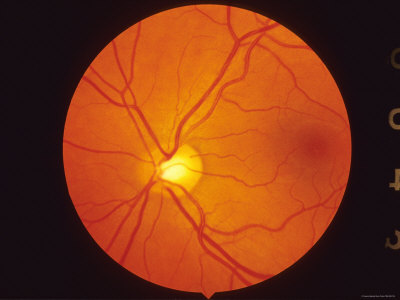 Normal Retina View Thru Fundus