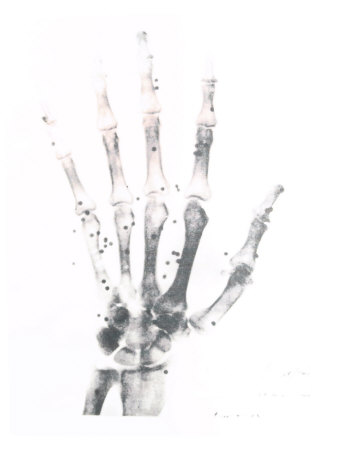 X-Ray Photograph of Hand of Person