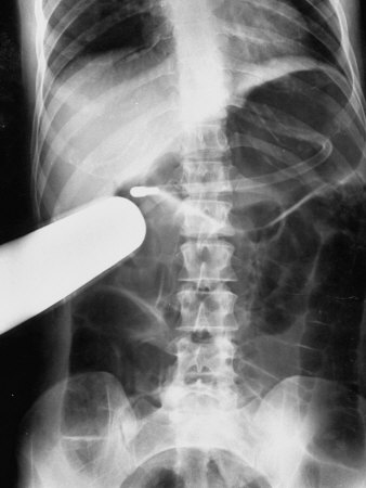 X-Ray Showing Tube Moving Through Patient