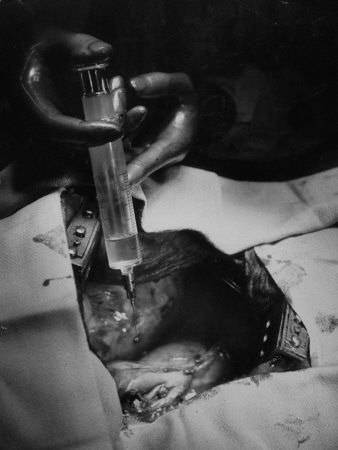 Nitrogen Mustard Is Dripped into Cavity Where Cancerous Lung Was Removed