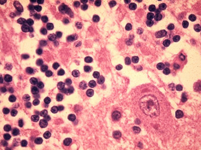 Brain of a Rabies Victim Showing Negri Bodies in the Cerebellum