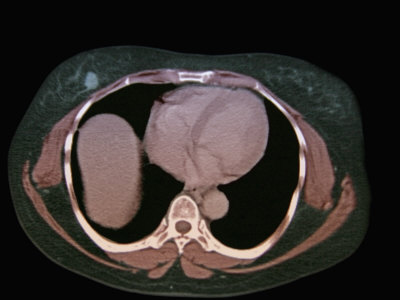 Right Human Breast Carcinoma Lesion Seen on an Abdomen Ct Scan