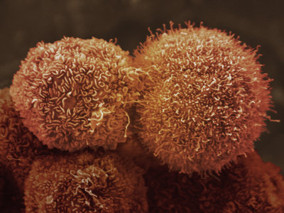 Human Pancreatic Cancer Cell, Cancer Research UK