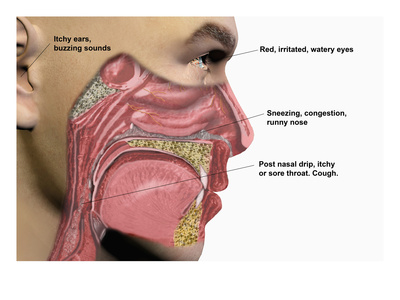 Illustration of Human Male Head Showing Mouth, Nose, and Throat Illustrating Allergy Symptoms
