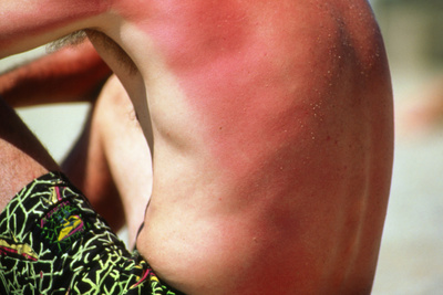 Sunburn on Man's Back And Arm