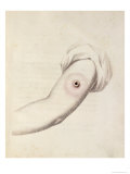 Buy Cowpox Pustule on an Arm, 1800 at AllPosters.com
