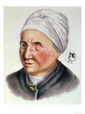 Buy Illustration from "Traite de Chirurgie Plastique" by Antoine Jobert de Lamballe Paris, 1849 at AllPosters.com
