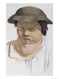 Buy Endemic Scrofula, Illustration from a Book by Baron Jean Louis Alibert at AllPosters.com