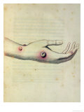 Buy Cowpox Pustule on the Arm of Sarah Nelmes at AllPosters.com