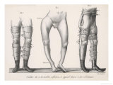 Buy Bow Legs and Their Treatment with Apparatus Intended to Straighten Them at AllPosters.com
