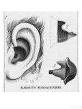 Buy Diagrams to Show Blodgett's Micro-Audiphone Hearing Aid and How It is Inserted into the Ear at AllPosters.com