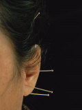 Close View of Woman Receiving Acupuncture Treatment Around Her Ears