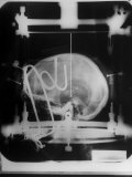 X-Ray Picture of Patients Skull in Metal Frame with Path of Needle Marked by "X"