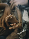 Buy Close View of the Twisted Feet of a Starving Child at AllPosters.com