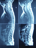 X-Ray Image of Person's Spine on Computer Screen