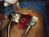 Surgery of the Shoulder