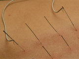Close View of Accupuncture Needles Treating a Stomach Ailment
