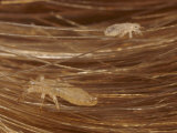 Head Lice Crawling Through Hair
