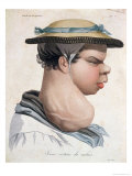 Buy Young Cretin from Valais, Illustration from a Book by Baron Jean Louis Alibert at AllPosters.com
