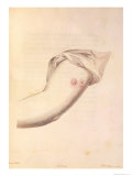 Buy Arm of William Pead Used For Smallpox Vaccine at AllPosters.com