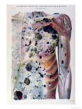 Buy Tumours and Cancerous Tubercles, from Anatomie Pathologique du Corps Humain by Jean Cruveilhier at AllPosters.com