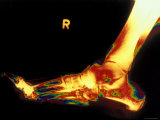 Buy X-Ray of Foot Right Foot at AllPosters.com