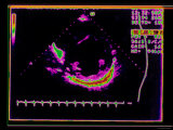 Echocardiogram, Hypertension