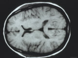 Buy Normal Head, Transverse Magnetic Resonance Image at AllPosters.com