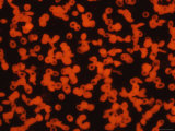 Buy Photomicrograph Sickle Cell Disease Rbc Genes at AllPosters.com