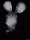 Siamese Twins X-Ray