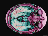 Buy Magnetic Resonance Imaging Head at Level of Orbits at AllPosters.com