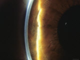 Ophthalmology, Cornea Slit-Lamp Examination
