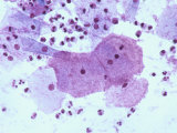 Buy Gardnerella Vaginalis Clue Cells Pap Smear X10 at AllPosters.com