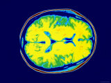 Buy Normal MRI Head Transverse Magnetic Resonance Image at AllPosters.com
