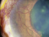 Buy Rubeosis Iridis Blood Vessels on Iris at AllPosters.com