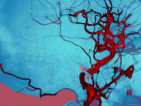Buy Blocked Vein Brain Burst Aneurysm Cerebral Blood at AllPosters.com