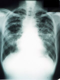 Buy Sarcoid of Lung X-Ray Lung X-Ray Sarcoid at AllPosters.com