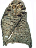 Buy Lung with Cystic Fibrosis at AllPosters.com