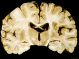 Buy Brain, Autopsy Section, Ventricles at AllPosters.com
