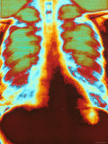 Buy Chest X-Ray, Pneumonia at AllPosters.com