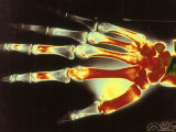 Digitized X-Ray of Normal Human Hand