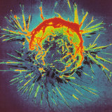 Breast Cancer Cell Gynecology Research