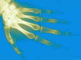 Xray of Normal Adult Hand Left Hand Dorsal View