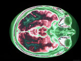 Buy Magnetic Resonance Imaging Head at Level of Orbits at AllPosters.com