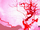 Buy Aneurysm Brain Vessels Cerebral Blood Burst Vein at AllPosters.com