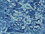 Buy Micrograph Skin Cancer Malignant Epidermis at AllPosters.com