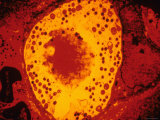 Buy Chlamydia Trachomatis Tem Urethitis and Cervicitis at AllPosters.com